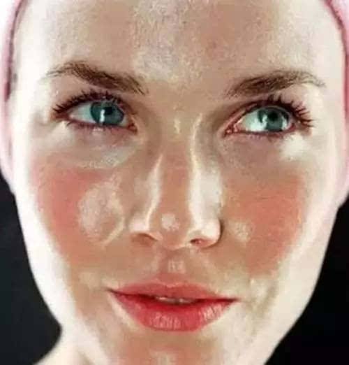 兰希黎：痘留在脸上的它||让人抓狂