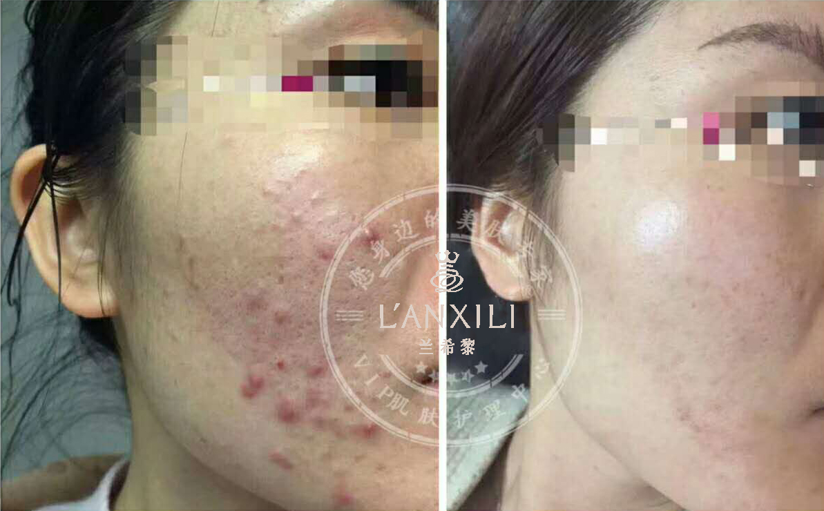 夏天痘痘祛斑全部爆发！！我这有妙招，教你如何轻松解决