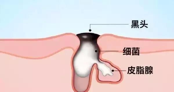 怎么才可以“告别”黑头呢？