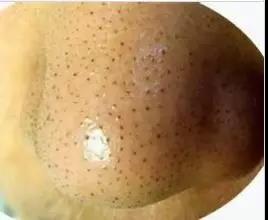 怎么才可以“告别”黑头呢？